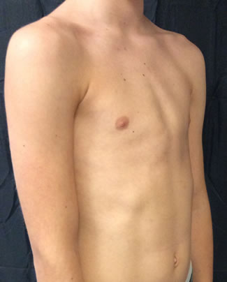 Pectus Carinatum