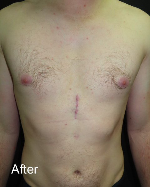 12 weeks after pectus non-corrective surgery with pectus implant