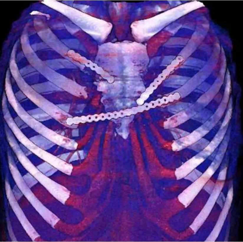 3D CT reconstruction showing three Nuss bars in situ following pectus excavatum correction