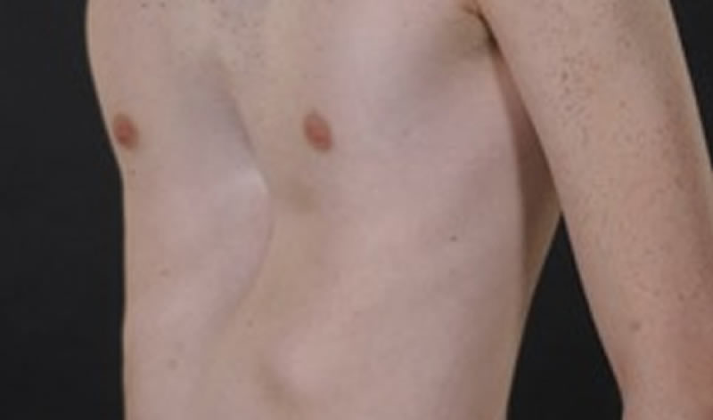 Asymmetrical pectus excavatum