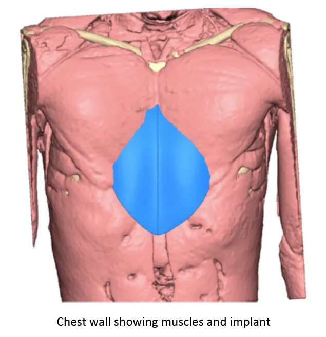 JF Chest wall showing muscles and implant