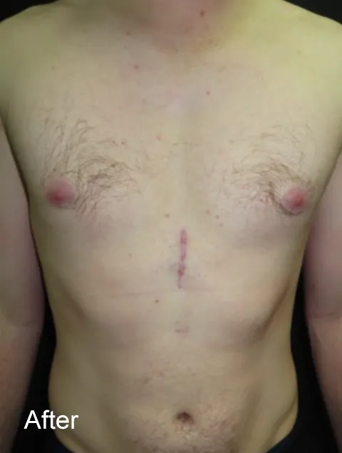 JF after Pectus Implants for severe pectus excavatum