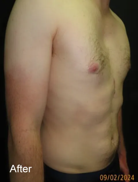 JF after Pectus Implants for severe pectus excavatum