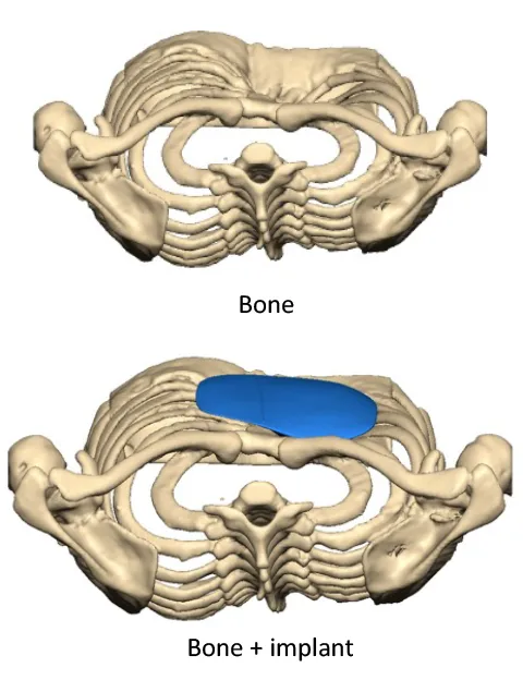 MB Pectus Implant Bone and implant