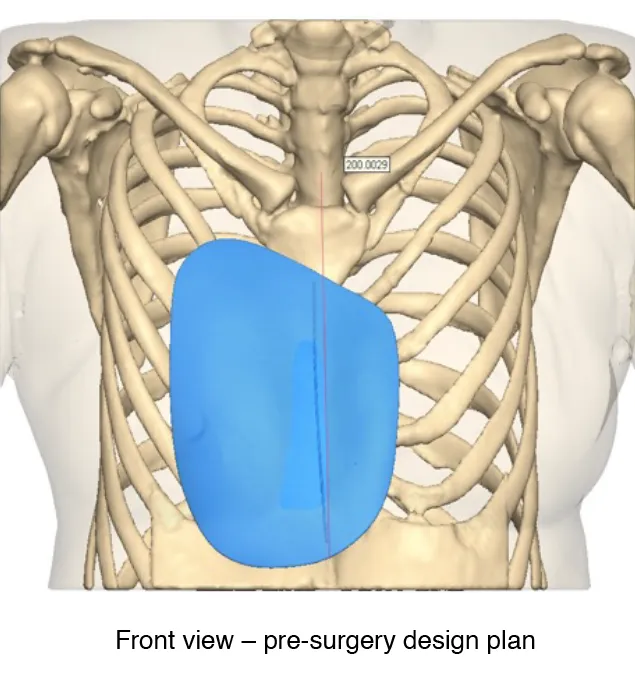 MB Pectus Implant Front view – pre-surgery design plan