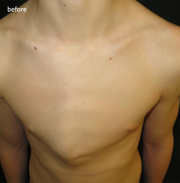 Pectus Carinatum Before