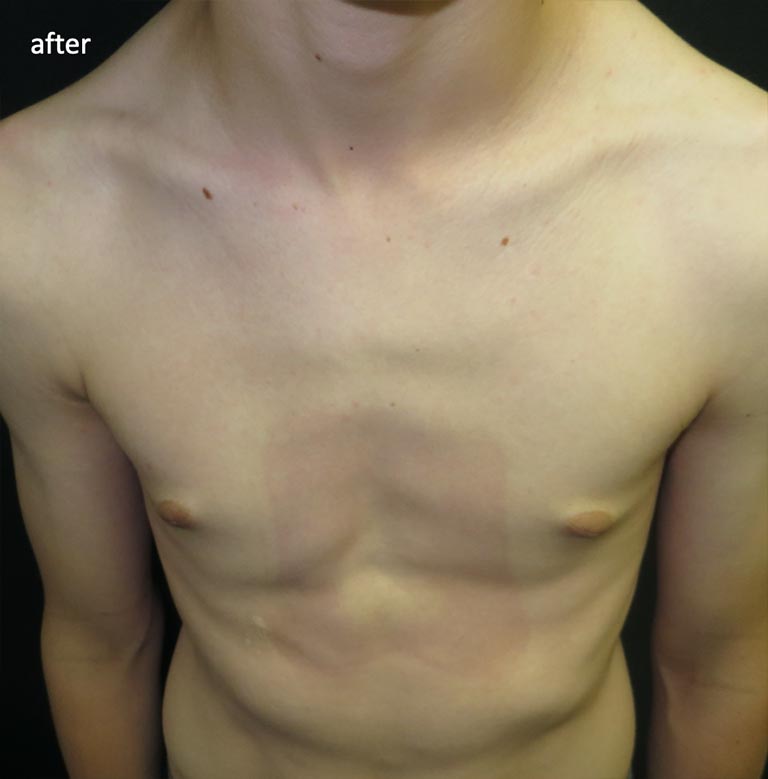 Pectus Carinatum After