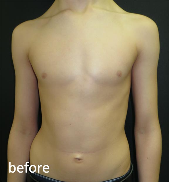 Pectus Carinatum Before