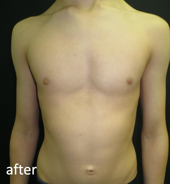 Pectus Carinatum After