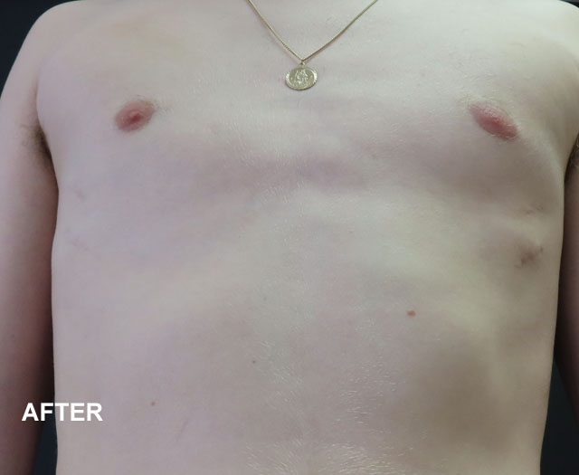 Cameron after Nuss Procedure pectus excavatum