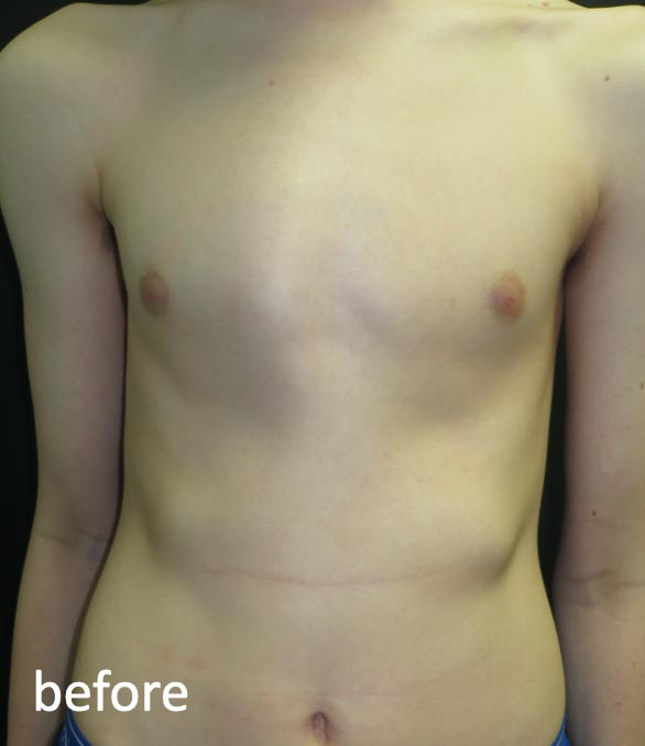 Pectus Carinatum Before