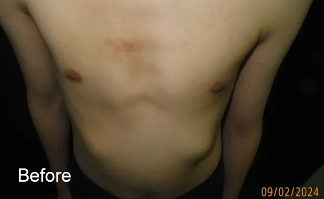 HD after external compressive bracing for asymmetric pectus carinatum