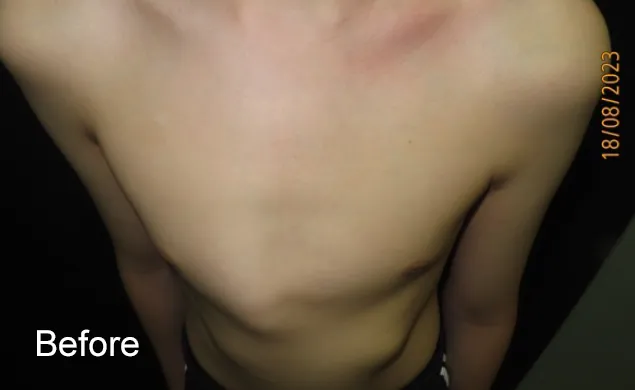 HD before external compressive bracing for asymmetric pectus carinatum