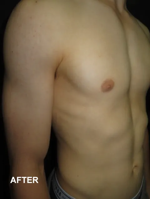 Henry after Vacuum Bell Therapy severe pectus excavatum