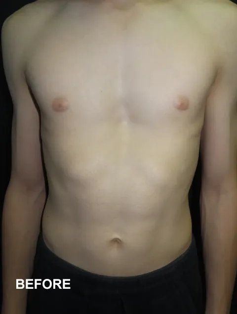Henry before Vacuum Bell Therapy severe pectus excavatum