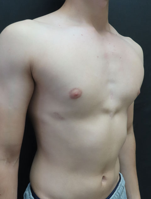 Jad one year after pectus excavatum treatment