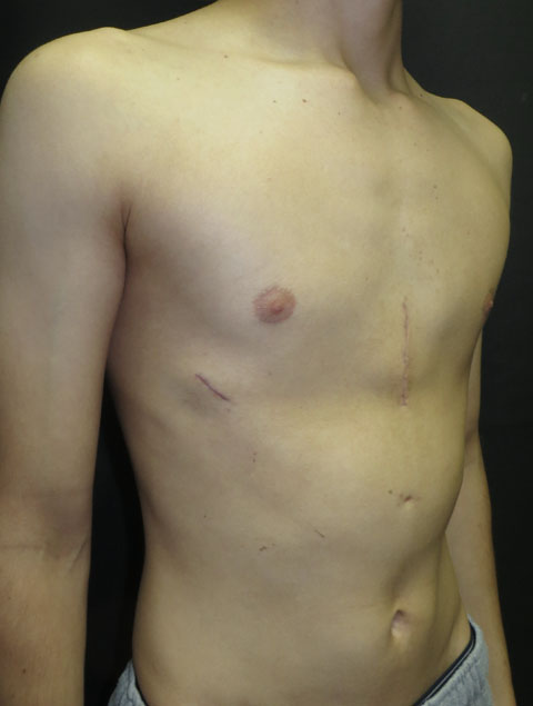 Jad two months after procedure for pectus excavatum