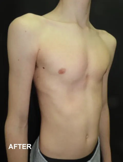 Jasper after having external compressive bracing for pectus carinatum