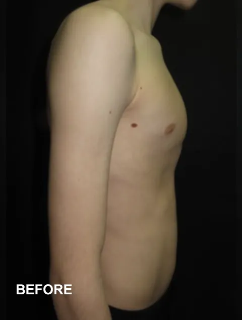 Jasper before having external compressive bracing for pectus carinatum