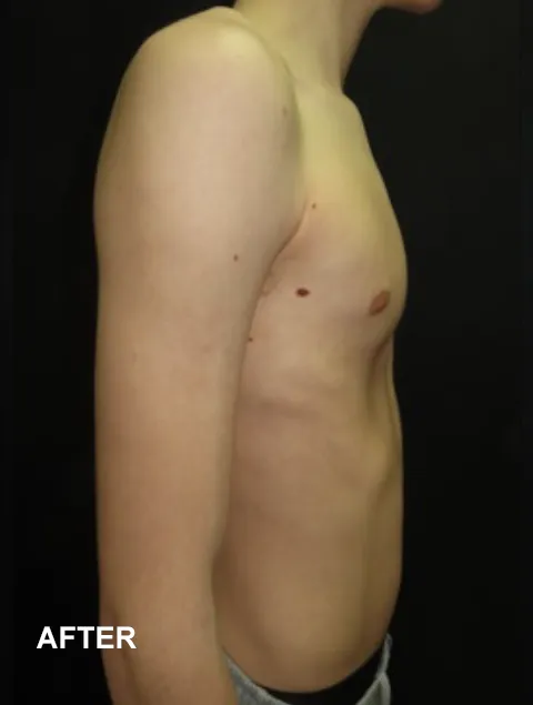 Jasper after having external compressive bracing for pectus carinatum