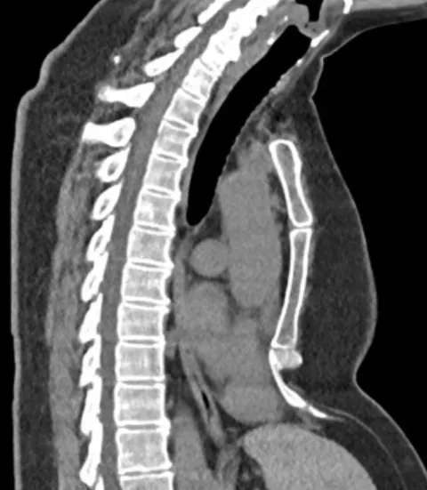 Chest CT before corrective surgery for pectus excavatum