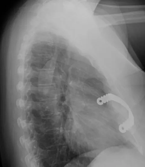 Chest x-ray following corrective surgery