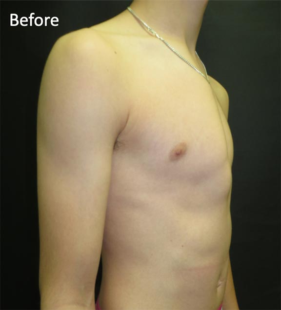 Pectus Carinatum Before