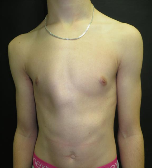 Pectus Carinatum Before