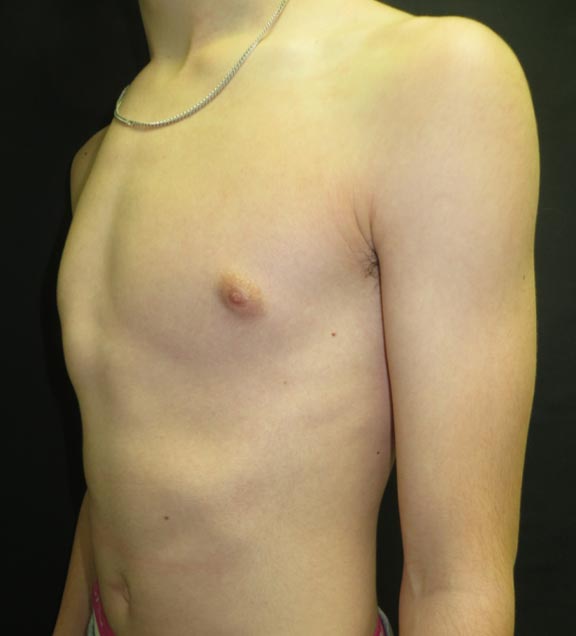 Pectus Carinatum Before