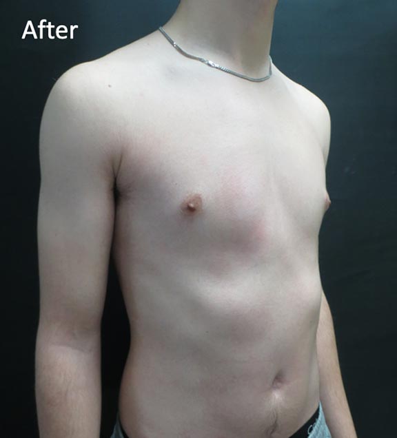 Pectus Carinatum After