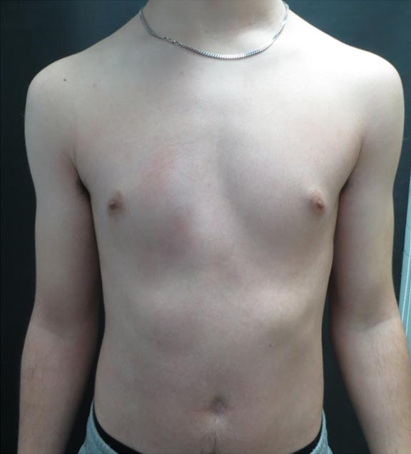 Pectus Carinatum After