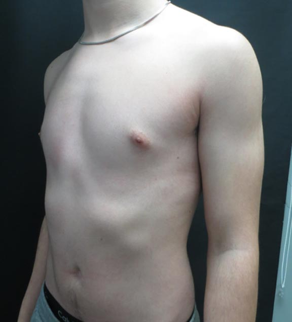 Pectus Carinatum After