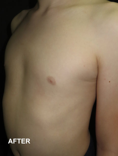 Noah after Pectus Excavatum treatment