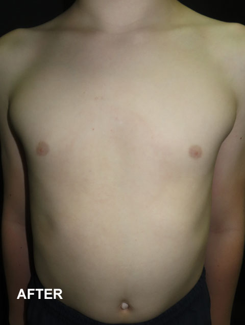 Noah after vacuum bell therapy for Pectus Excavatum