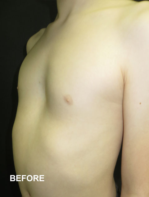 Noah before Pectus Excavatum treatment