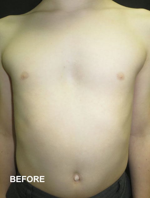 Noah before vacuum bell therapy for Pectus Excavatum