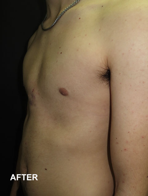 Oliver after having pectus carinatum treatment