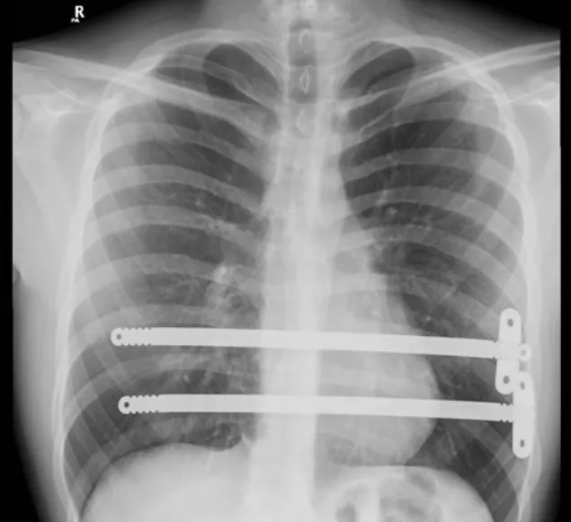 Oliver chest x-ray after Nuss procedure for severe pectus excavatum