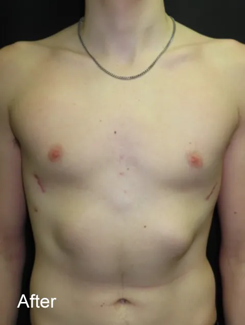 Oliver before Nuss procedure for severe pectus excavatum