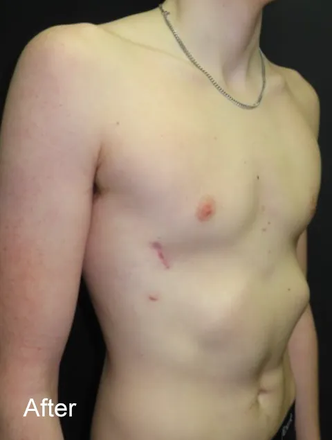 Oliver after Nuss procedure for severe pectus excavatum