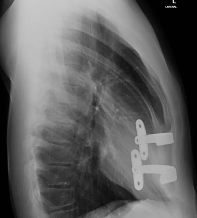Oliver chest x-ray after  Nuss procedure for severe pectus excavatum