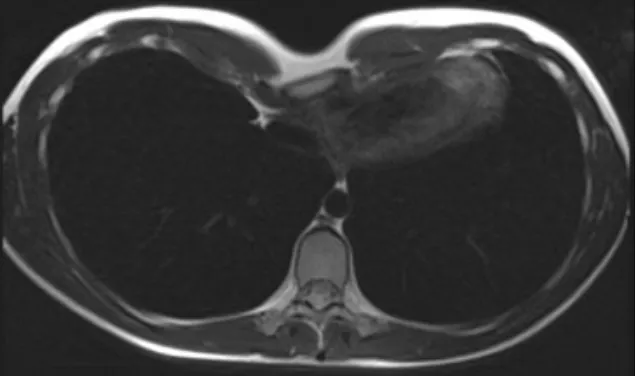 Oliver CT Scan Nuss procedure for severe pectus excavatum