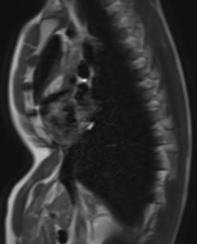 Oliver CT Scan Nuss procedure for severe pectus excavatum