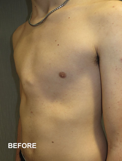 Oliver before having pectus carinatum treatment