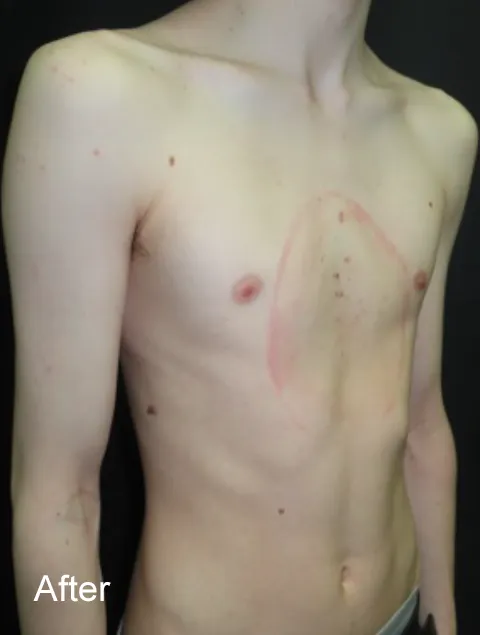 Patrick after Vacuum Bell Therapy severe pectus excavatum