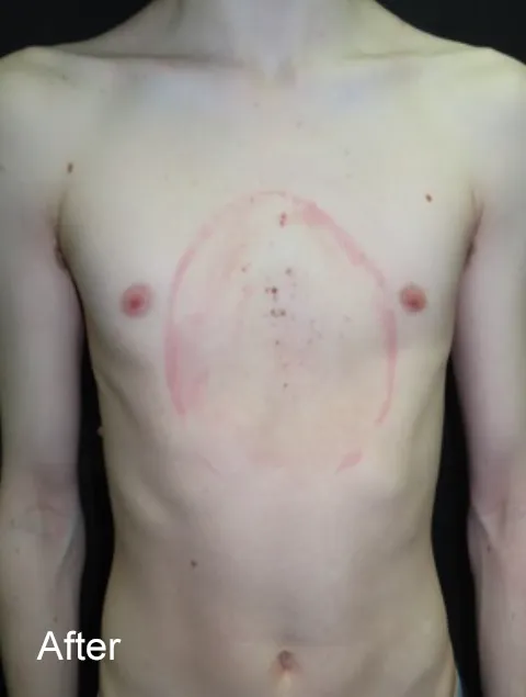 Patrick after Vacuum Bell Therapy severe pectus excavatum