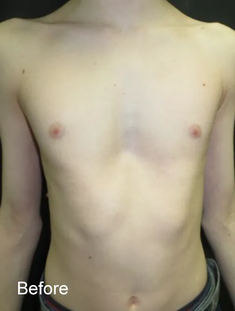 Patrick before Vacuum Bell Therapy severe pectus excavatum