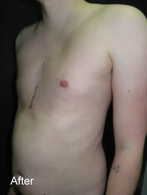 Sam after Pectus Implant for pectus excavatum