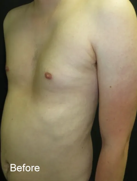 Sam before Pectus Implant for pectus excavatum