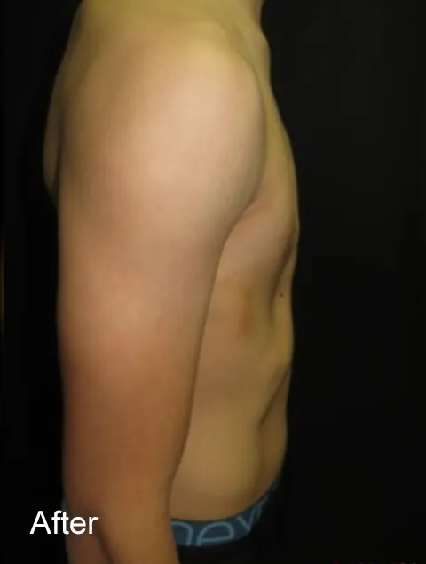 TE after external compressive bracing pectus carinatum